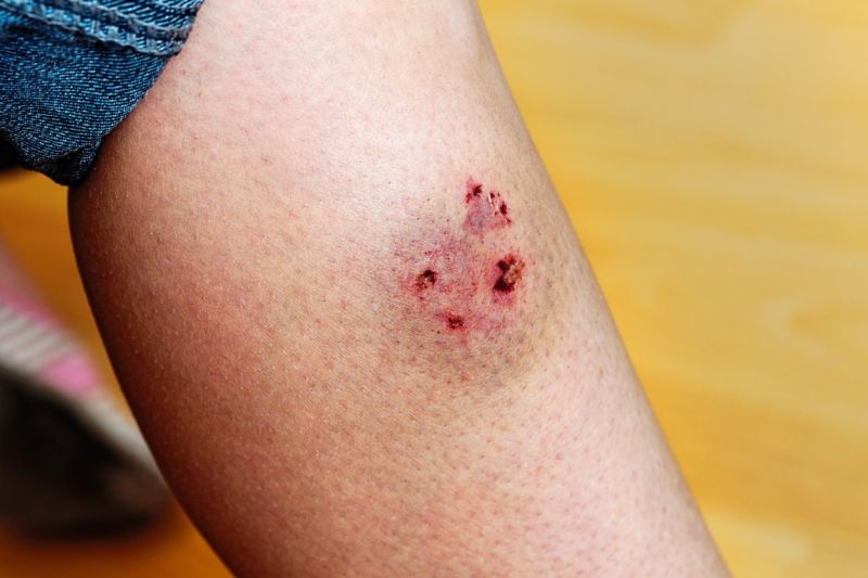 Dog bite leaves puncture marks and bruise on woman's leg